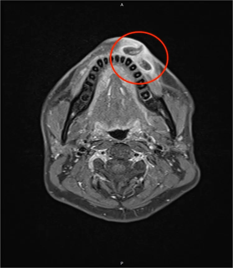 核磁共振檢查顯示陳先生的嘴唇有異物。馬偕提供