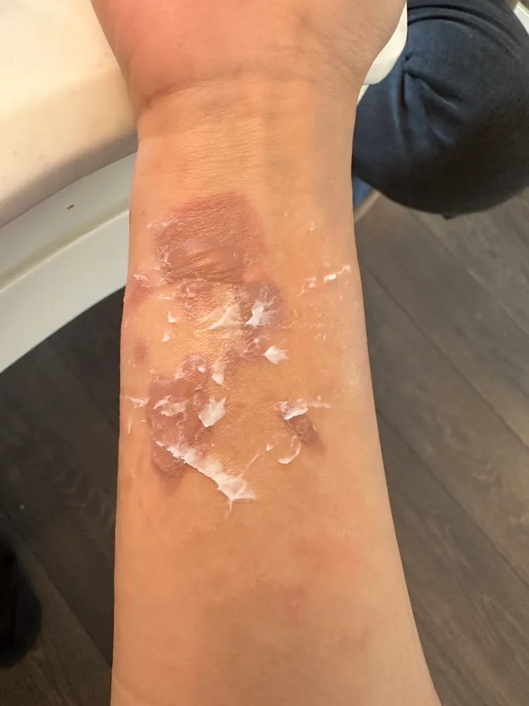 丟丟妹燙傷後隔天才擦藥膏。《樓頂揪樓下》提供