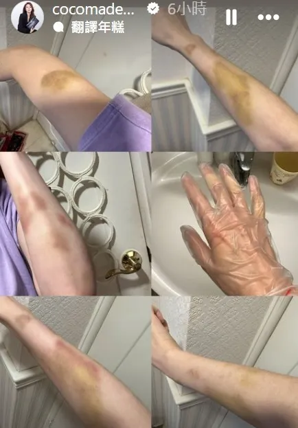 林千又一身是傷。翻攝林千又IG