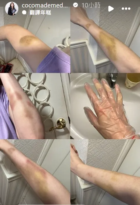 林千又貼出傷勢照。翻攝自林千又IG