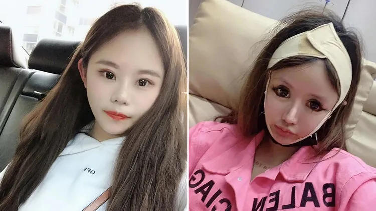 周楚娜過去隆鼻後及在其他手術恢復期時的情況。翻攝自《頭條新聞》