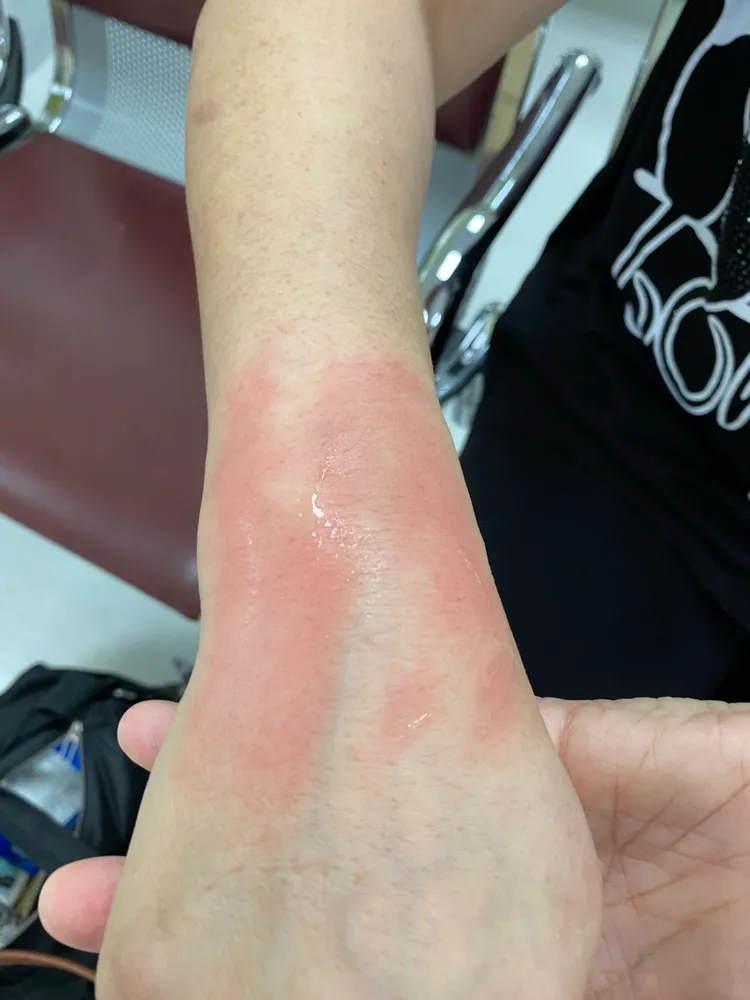 思思在賣場誤踩臺車摔倒，右手橈骨骨折。思思提供