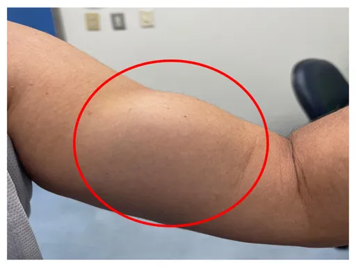 美魔女啞鈴舉到手臂長「二頭肌」　竟是肌腱斷裂！微創手術縫合