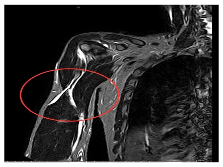 核磁共振（MRI）影像顯示，病患的肱二頭肌長頭斷裂（紅圈處）。院方提供