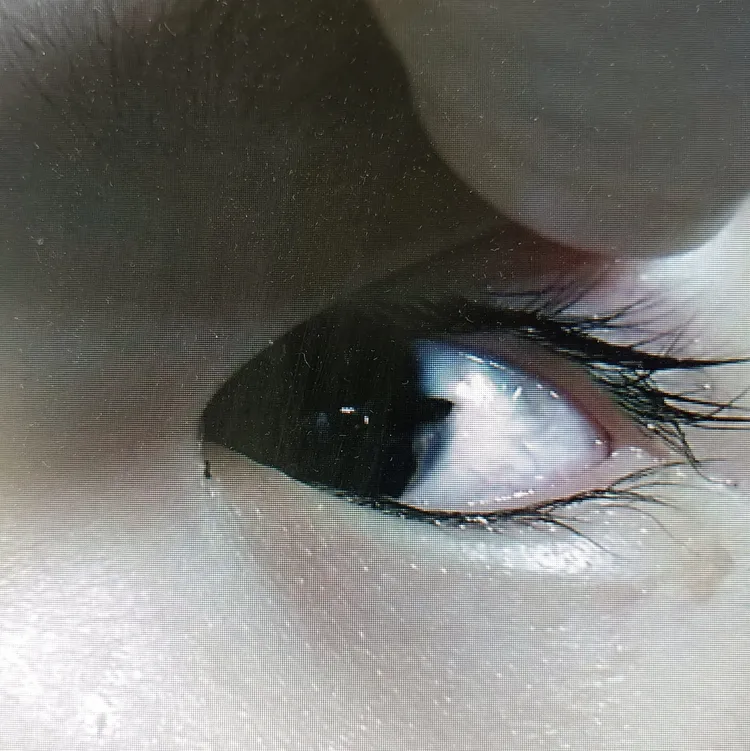 4歲童「眼球被刺破」眼白被劃開。翻攝自臉書粉專「黑倫醫師x健康諮詢」