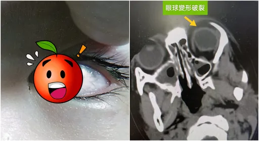 以為是筆！4歲童「眼球遭刺破」眼白被劃開　醫師示警：千萬別用