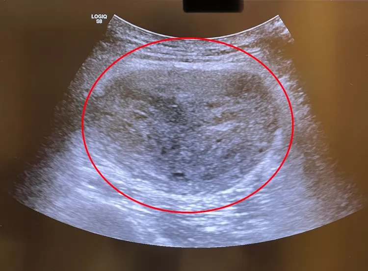 超音波影像檢視腫塊十分異常，建議進一步檢查及治療。院方提供