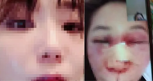 女客控房东说「想睡妳」!痛殴毁容要杀人 还嚣张追进医院