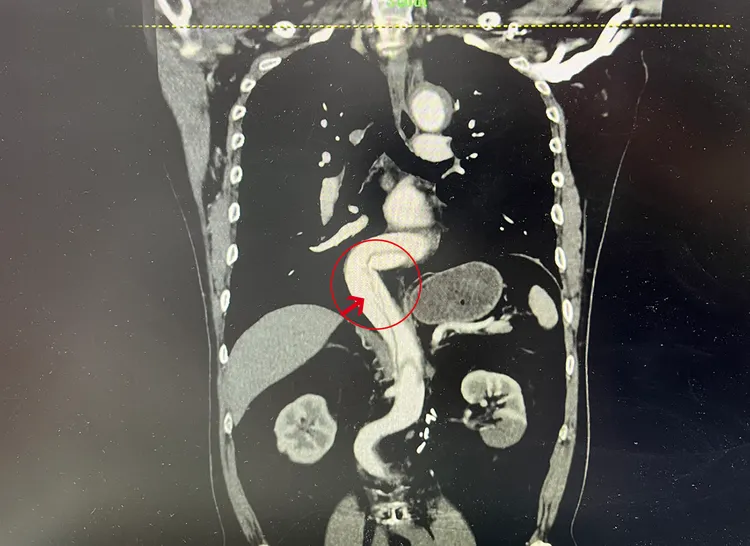 箭頭指出的長黑影，為腹部動脈破裂情形。院方提供