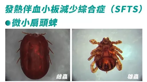 日本出現首例「人傳人蜱蟲病」 疾管署提醒防護:致死率最高15%
