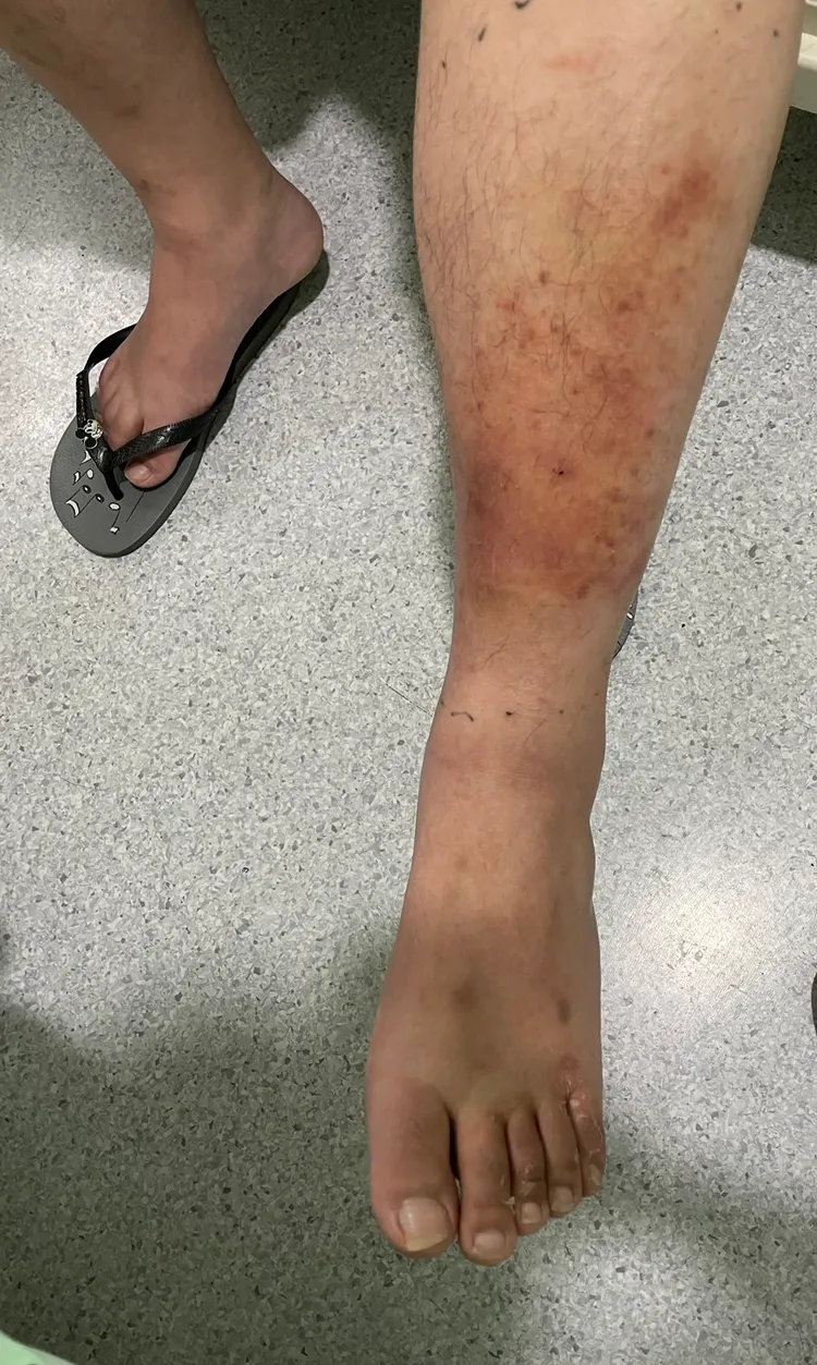 黃姓運將左小腿紅腫就醫，發現竟是香港腳引發感染蜂窩性組織炎。院方提供