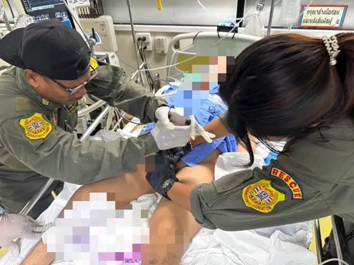 好玩嗎？套11個鋼圈腫成大熱狗　拔不出來緊急求醫切斷