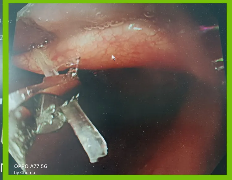 老翁大口吃魚，魚刺卡喉。翻攝自「黑倫醫師x健康諮詢」臉書