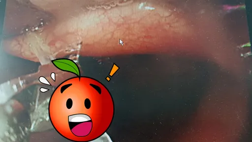 魚刺梗喉「快吞飯」是錯的!5大錯誤刺更深 醫師看「證據」:真嚇人