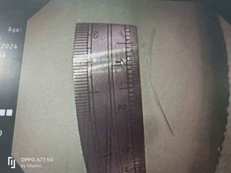 魚刺長約3公分。翻攝自「黑倫醫師x健康諮詢」臉書