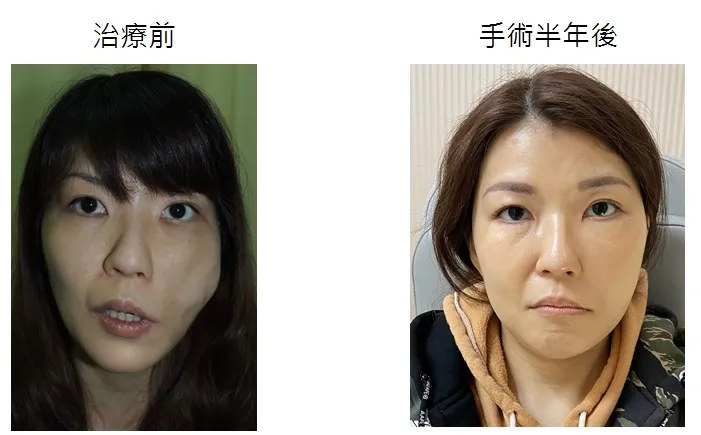 小惠治療前後也有明顯改善。院方提供