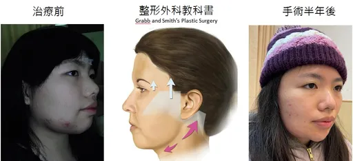 高位筋膜拉皮手術改善血管畸形瘤 助「草莓女孩」重展笑顏