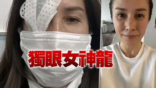 視力越來越模糊！高金素梅今緊急開刀　「獨眼」虛弱照曝光