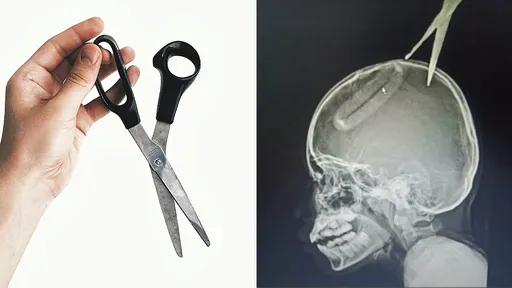 4歲弟重視電視劇打鬥　「剪刀飛射」刺入10歲姊頭骨2.5公分