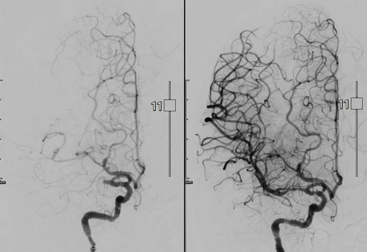 北醫附醫動脈取栓團隊成功吸出出血栓並打通血管。圖為腦血管打通前（左圖）後（右圖）比較。北醫附醫提供