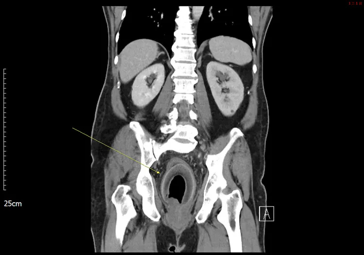 男子直腸塞進一棵小椰子，造成大小便困難。義大提供
