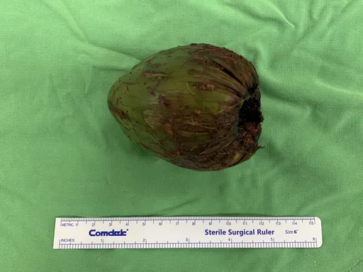 奇!男子把椰子塞肛門 醫傻眼:徒手伸進去也拿不出