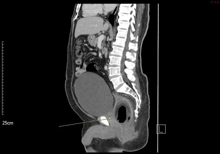 男子直腸塞進一棵小椰子，造成大小便困難。義大提供
