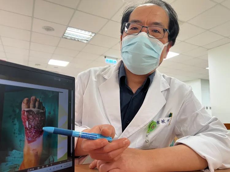 黃敏旭醫師說，患者到院時可見右腳腳背整片皮都被掀起。院方提供