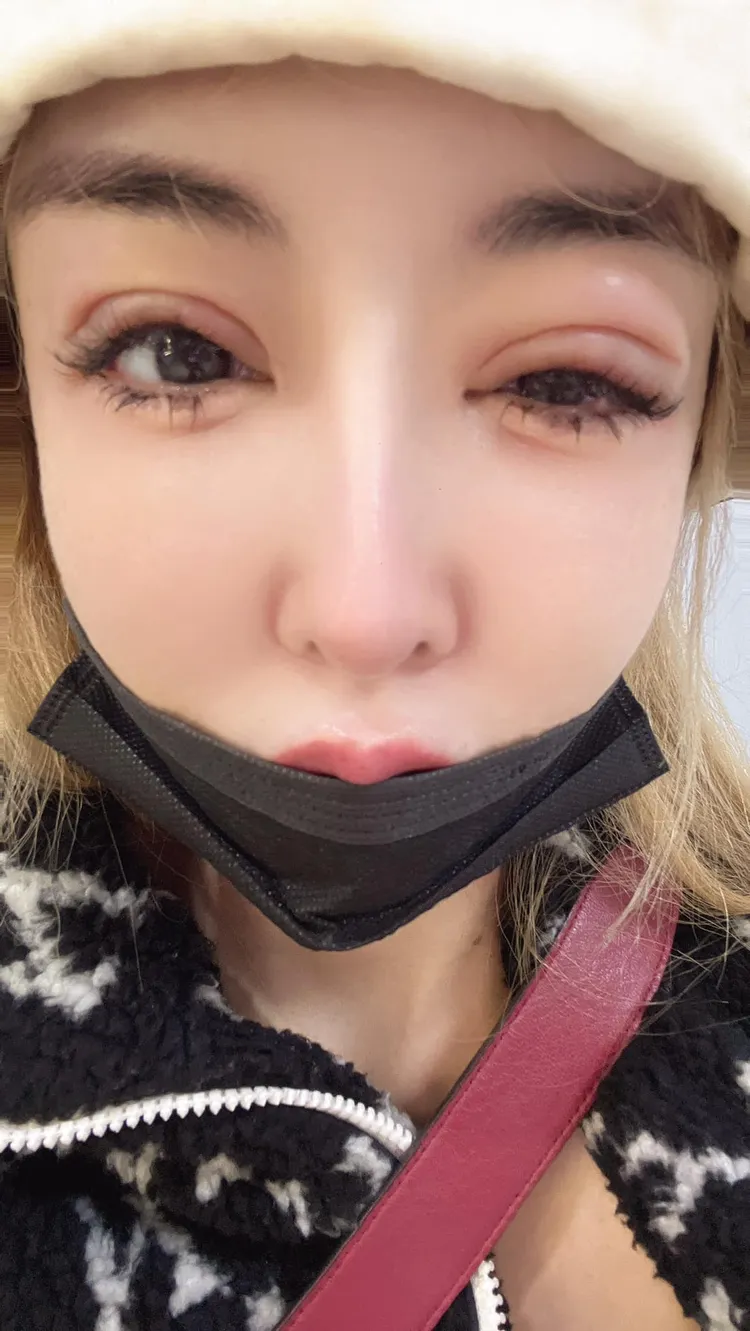 雪碧發現自己眼睛及眼皮又癢又腫，擔心自己毁容。翻攝雪碧臉書