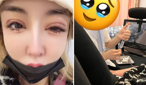 「情色教主」雪碧臉腫得像豬頭!驚秀毁容照憂整太多後遺症