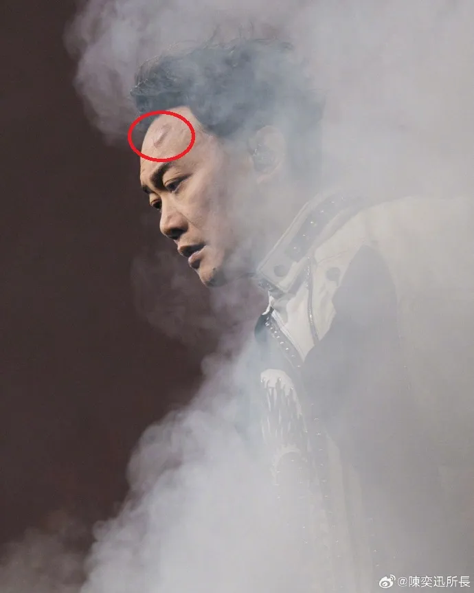 陳奕迅頭上的包相當明顯。翻攝陳奕迅所長微博