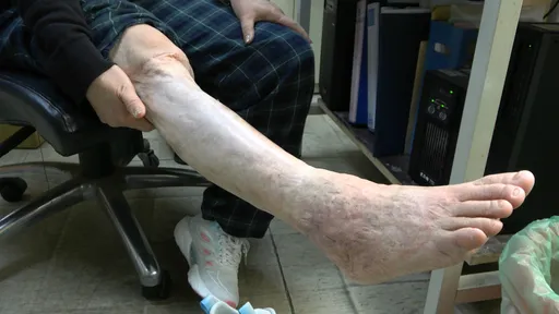 右腿裝400支釘子、開刀逾百次　她自製白沙屯媽祖結緣品還願