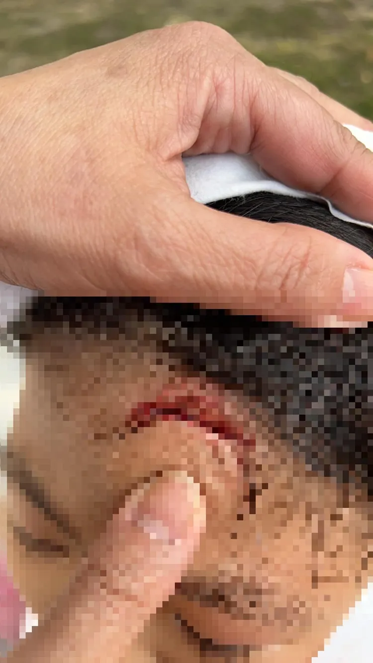 有國小女童撞破頭，留下長約5公分傷口。家長提供