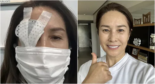 高金素梅眼睛緊急開刀 醫曝術後照護5重點