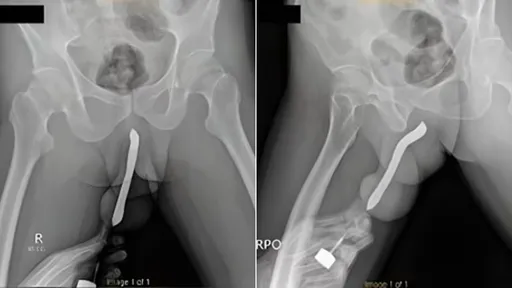 43歲男「牙刷塞入陰莖」激戰騎乘位　啪！香蕉斷成茄子求救