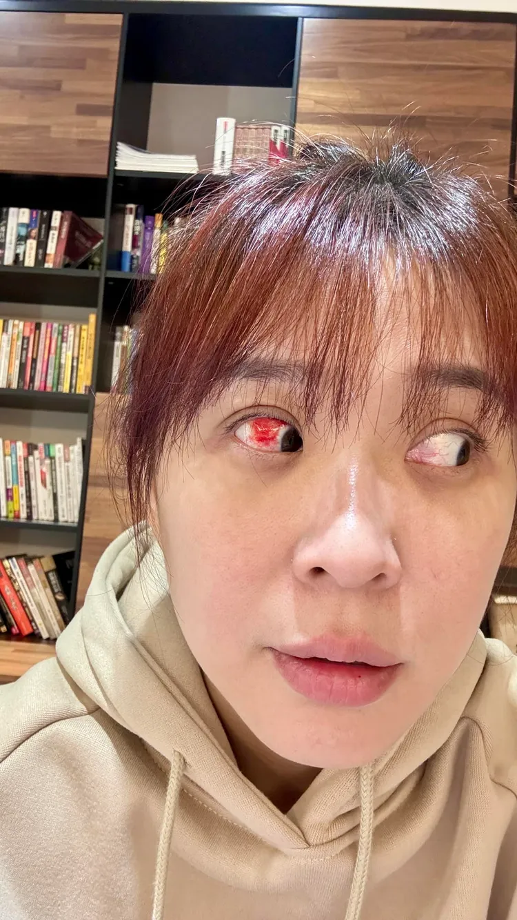 李燕眼球爆血，照片令人嚇一跳。翻攝自李燕臉書
