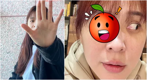 本土劇女神眼球爆血　慘不忍睹照曝光！網看傻：快就醫