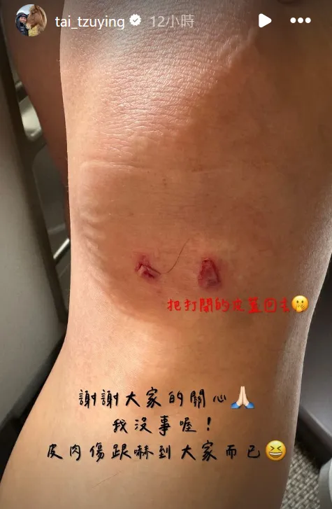 戴資穎傷勢照，並寫下「把打開的皮蓋回去」。翻攝自戴資穎IG