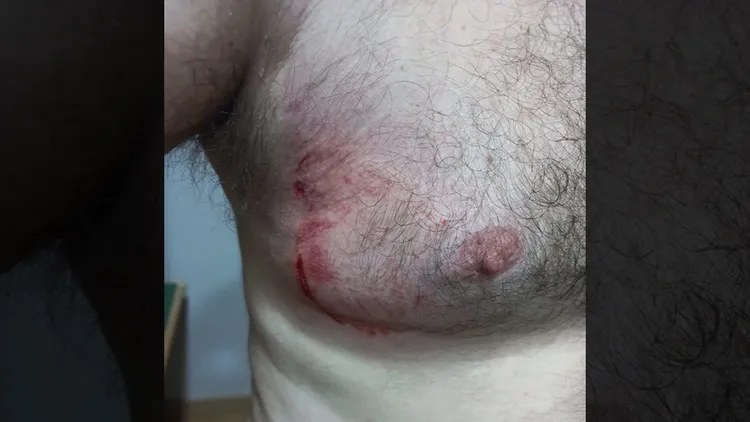 雷納托的傷勢。翻攝自推特