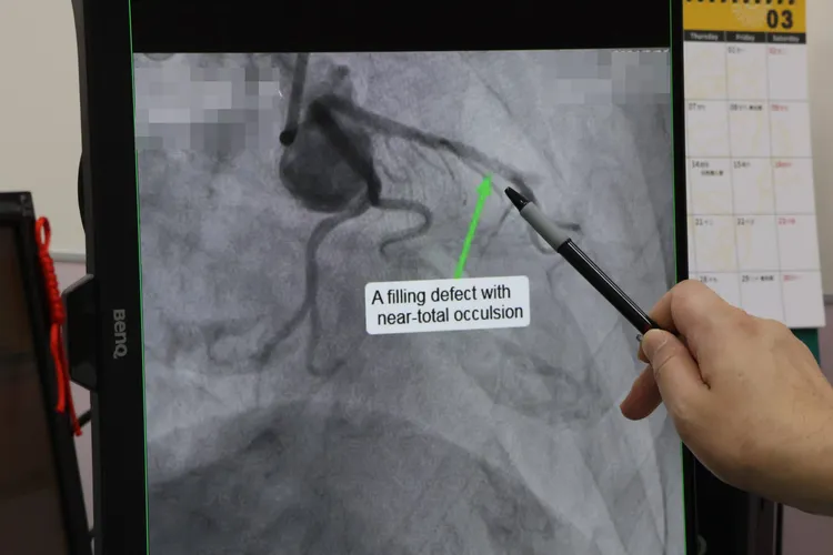 周姓阿嬤在遶境中途心肌梗塞，進行心導管手術裝支架。院方提供