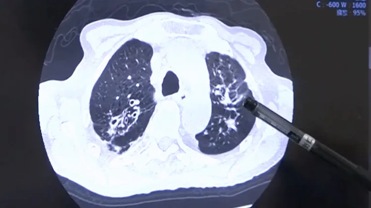 筆端所指即為肺結核陰影。彰化醫院提供