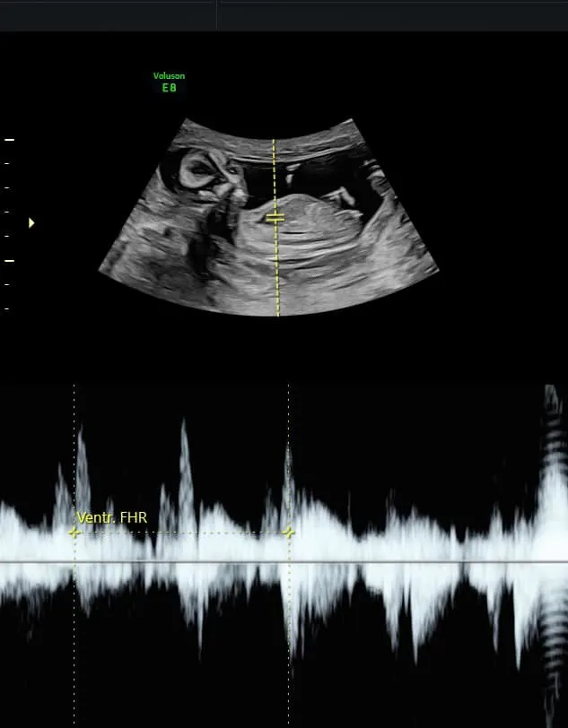 劉香慈開心表示，寶寶心跳聲好迷人。翻攝劉香慈臉書