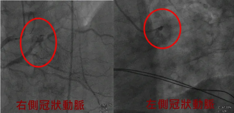 患者雙側冠狀動脈嚴重阻塞。院方提供
