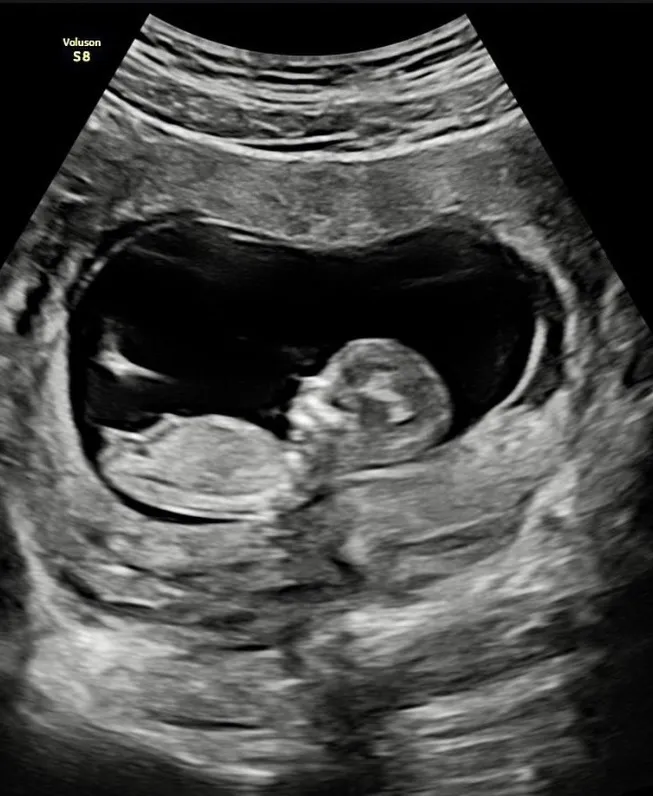 賴弘國秀出老婆超音波宣布二寶喜訊。翻攝賴弘國IG