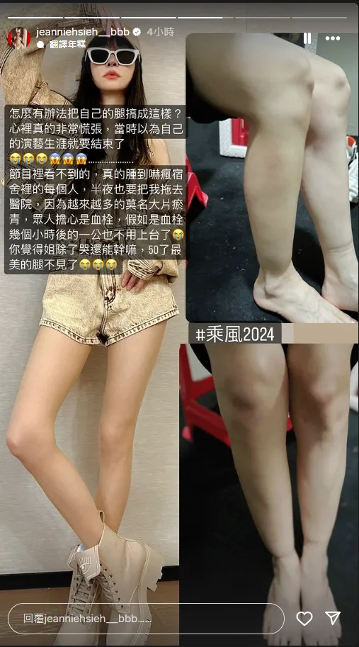 謝金燕分享雙腿腫脹、瘀青慘照。翻攝謝金燕IG