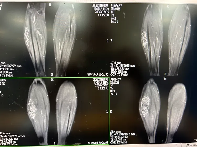 劉彥澧表示，右小腿血管瘤仍在。劉彥澧提供