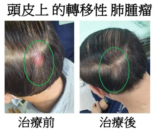 頭皮長腫塊、落髮竟是肺癌4期轉移 免疫治療讓他再現濃密黑髮