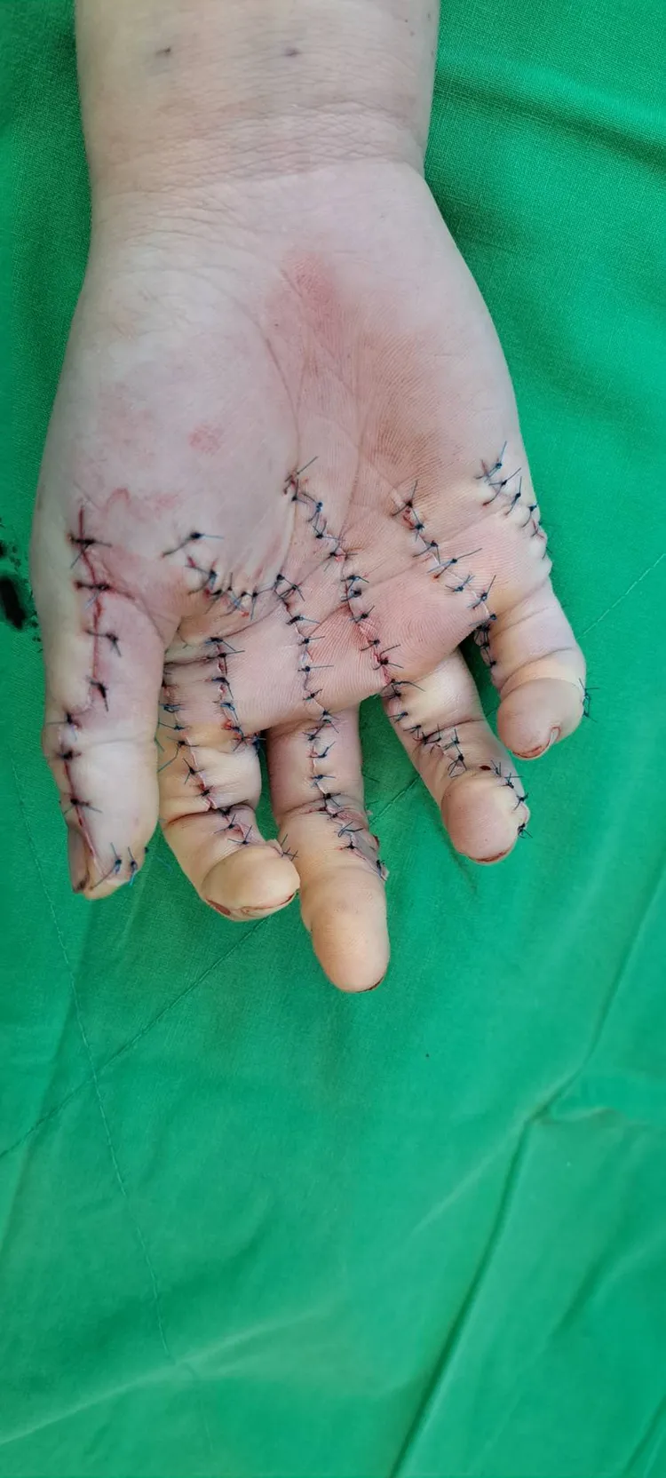 彰化秀傳醫院緊急為女傷者手術縫合。彰化秀傳提供