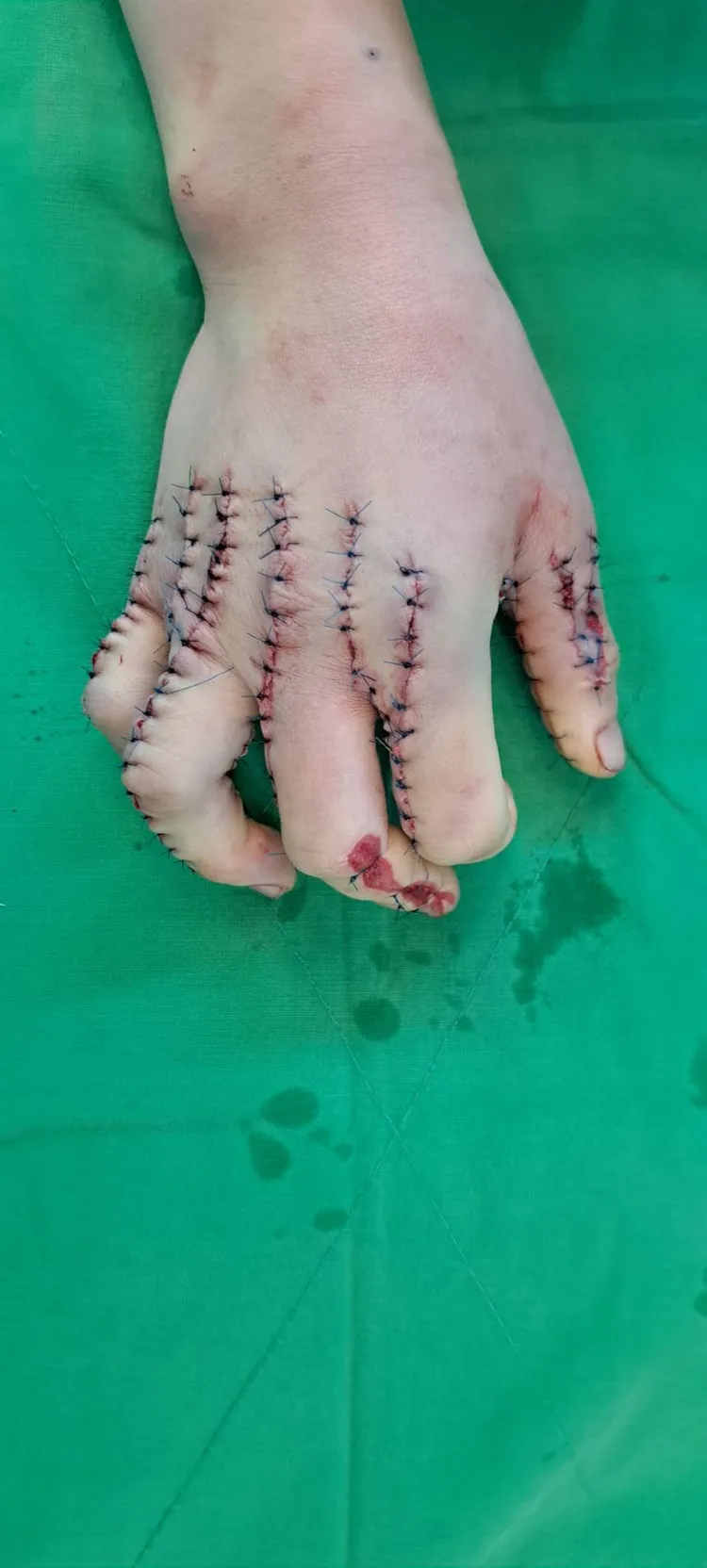 彰化秀傳醫院緊急為女傷者手術縫合。彰化秀傳提供