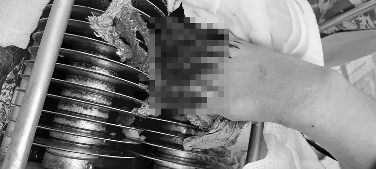 傷者幾乎整個手掌捲入絞肉機。彰化秀傳提供